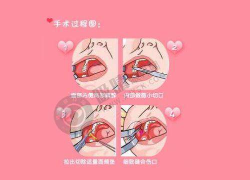 顾客见证与口碑传承：重庆铜雀台郑胜医生真实实例彰显面部除皱实力