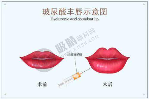 全切双眼皮 + 开眼角整形修复时间