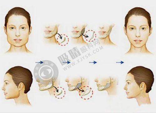 玻尿酸垫下巴会移位吗？揭秘大分子玻尿酸塑形效果与术后护理要点