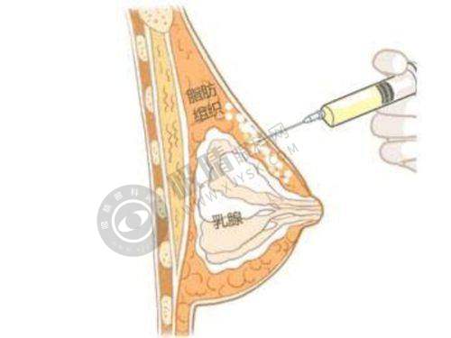 全切双眼皮 + 开眼角整形成效