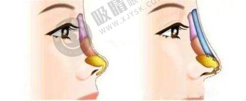 绍兴柯桥金柯桥医院植发科植发技术