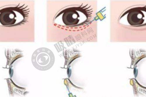 贵州磨骨手术哪里好?2025贵阳磨骨医院排名TOP3,3万起价,效果自然!