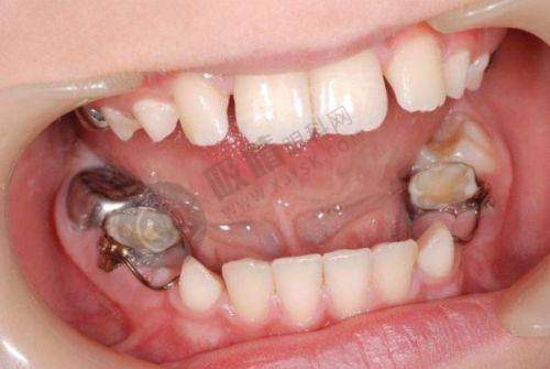 半固定种植牙是什么?材料解析+与全固定区别,医生教你这样选!