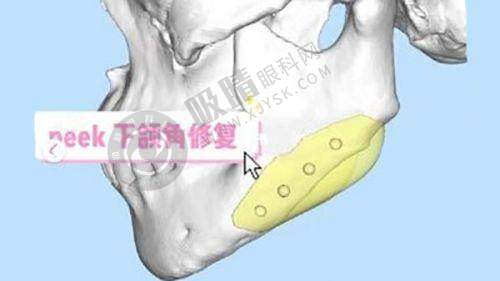 北京张医生脂肪填充效果如何?苹果肌+泪沟仅18000元起,真实案例曝光