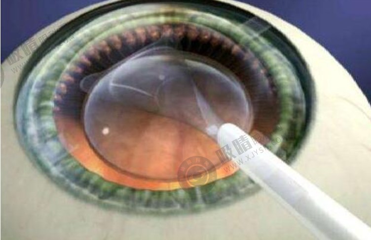 太学眼科门诊部人工晶状体植入手术费用一览：双焦点晶体6.69千元+/三角点晶体1.7万元+