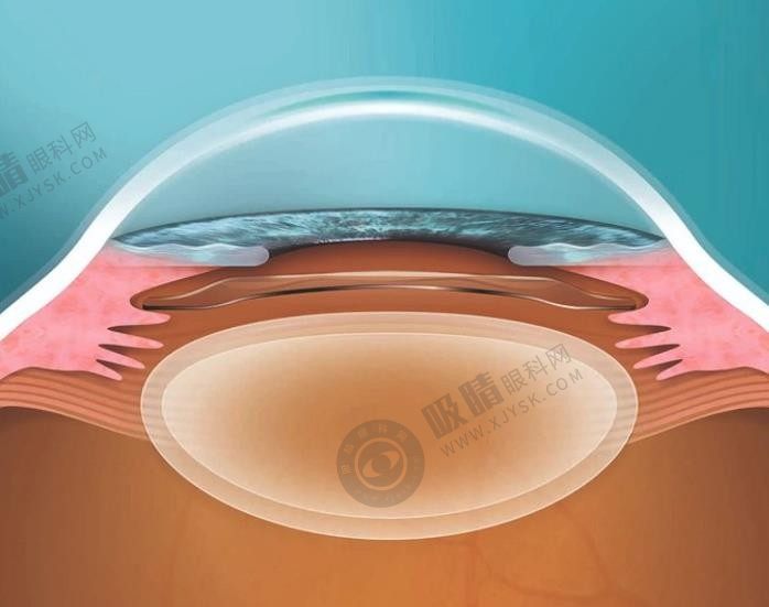 苏州市太学眼科门诊部人工晶状体植入术价格明细: 双焦点晶体6.69千元+/三角点晶体1.7万元+