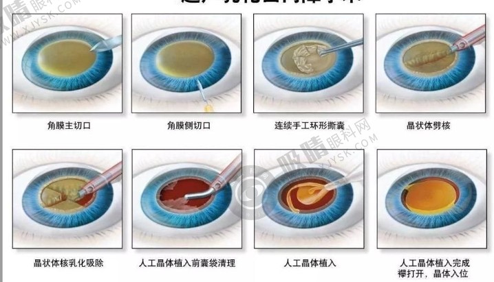 微切口白内障手术.png