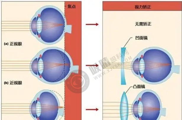 儿童近视矫正.png