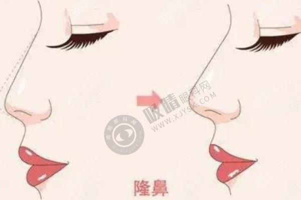 东王荟隆鼻整形